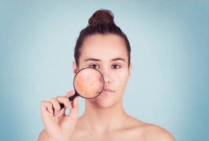 Woman holding a magnifying glass up to acne on her cheek.