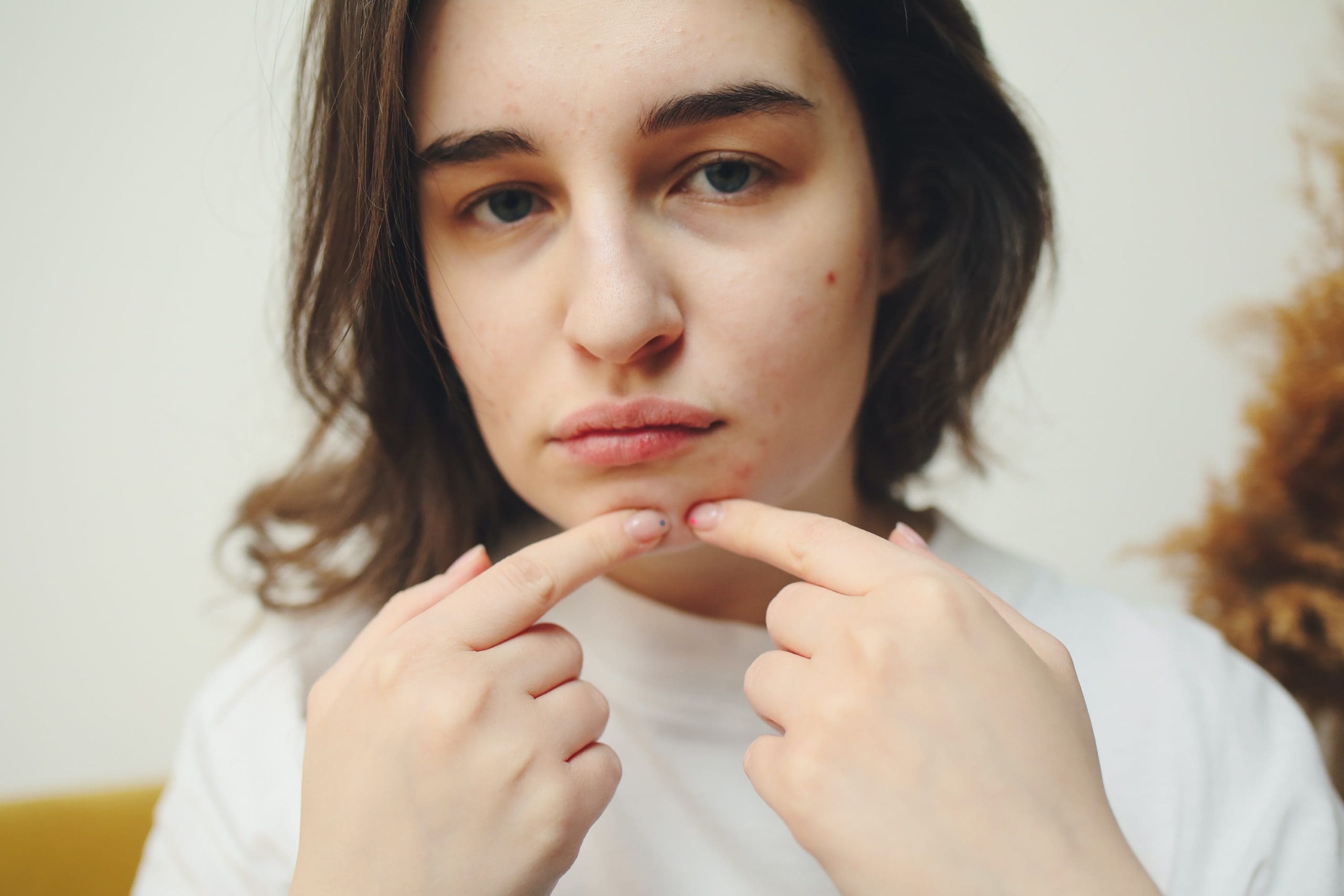 woman-acne-face Topical cannabis can help woman with acne